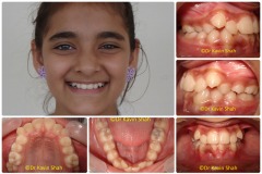 1-Crooked-Teeth-Before-Braces-Treatment