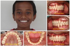 10-Under-Bite-correction-in-Kids-After-Braces-treatment