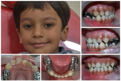 13-Root-canal-and-metal-cap-in-kids
