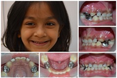 15-Fillings-and-Root-canal-in-Kids