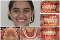 2-Straightened-Teeth-After-Braces-Treatment