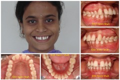 3-Gaps-in-between-Teeth-Before-Braces-Treatment