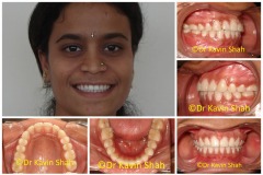4-Gaps-filled-After-Braces-Treatment
