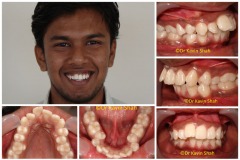 5-Front-Teeth-Jetting-out-Before-Braces-Treatment