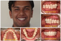 6-Front-teeth-pushed-in-with-Braces-Treatment