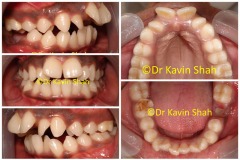 7-Open-Bite-Before-Braces-Treatment