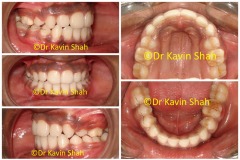 8-Normal-Bite-After-Braces-Treatment