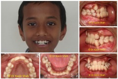 9-Under-Bite-in-Kids-Before-Braces-treatment