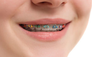 Cost Of Transparent Braces In Mumbai