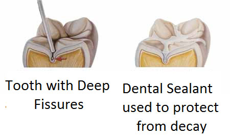 Dental Sealants For Prevention Of Cavity In Kids