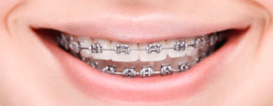 Metal Braces Treatment In Mumbai