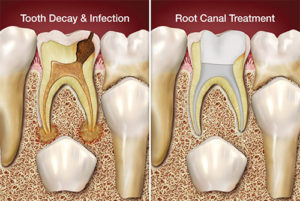 Root Canal In Kids