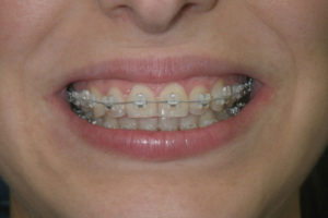 Self Ligating Braces Andheri Mumbai