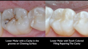 Tooth Filling In Kids